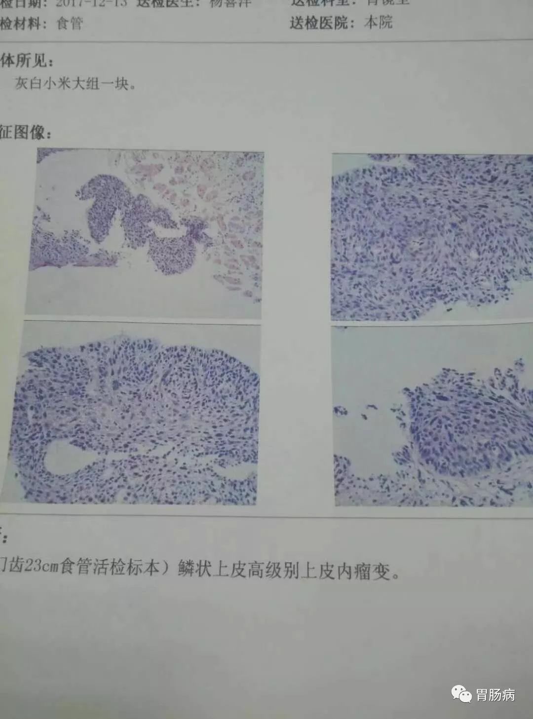 意外做了个胃镜，竟然发现个早癌