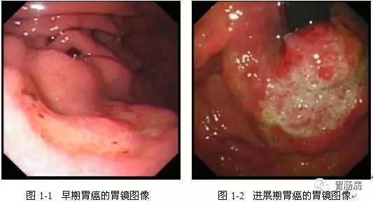 胃溃疡癌变都有哪些信号？怎么预防？