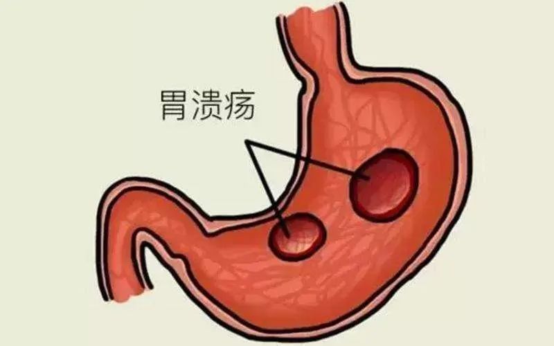 动不动就嗳气？背后有哪些原因？如何预防？