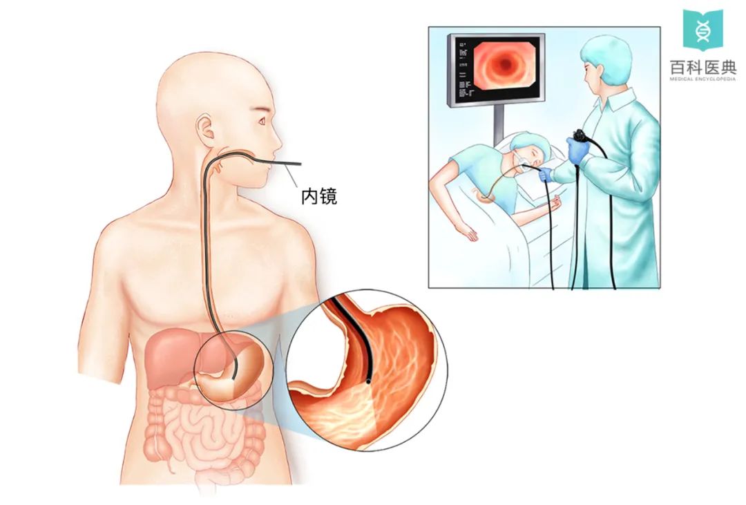 慢性萎缩性胃炎”多久复查一次胃癌能防癌？