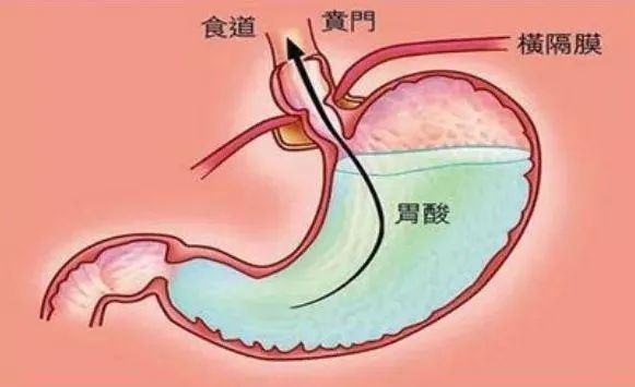 胃溃疡是怎么形成的？跟这些因素有关，快来了解下