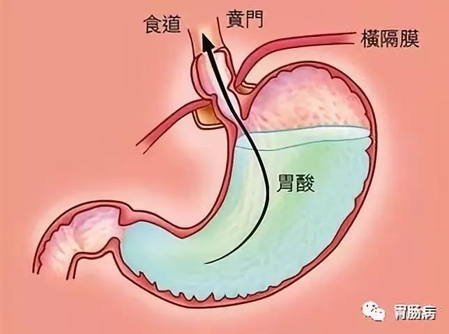 胃食管反流病的预防和日常保健