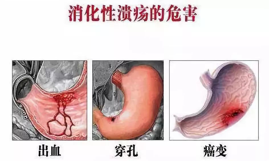 4种最常见胃溃疡症状！针对性治疗最关键