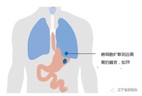 5张图片让您过目不忘胃癌分期