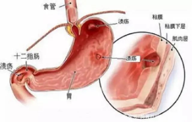 胃溃疡患者出现这些表现症状了在日常生活中应该做到这四点！