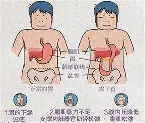 胃痛都是病，你知道自己属于哪种胃病吗？