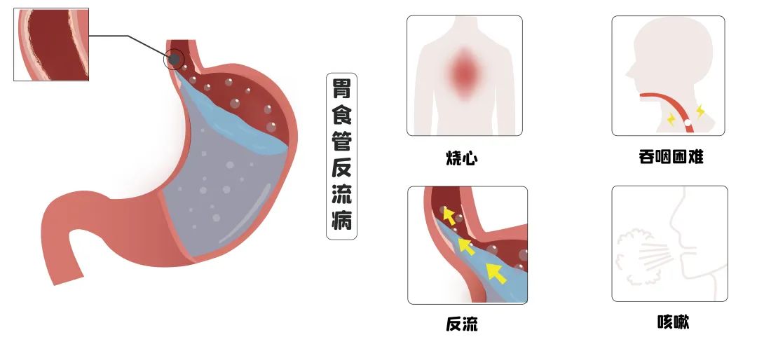 照顾好你的消化系统，胃食管反流，日常饮食要注意