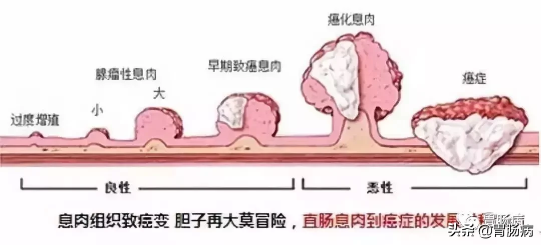 息肉，就是癌的近亲...