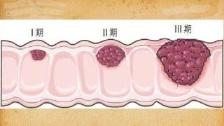 【科普】谈谈结直肠癌的元凶——“大肠腺瘤”~