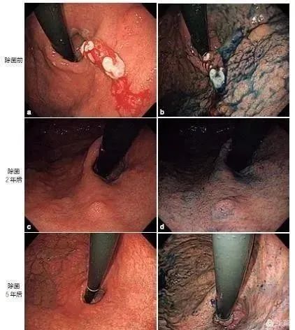 惊！35岁女性患者胃内密密麻麻长了100多枚息肉……