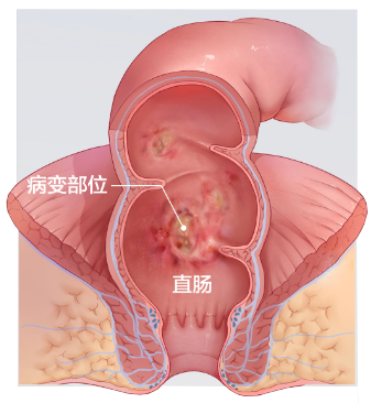 消化科医生提醒：一旦出现这些症状，就必须做肠镜检查了！