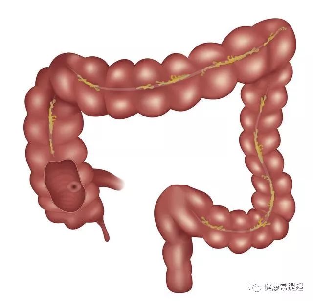 最常见的恶性肿瘤，大肠直肠癌