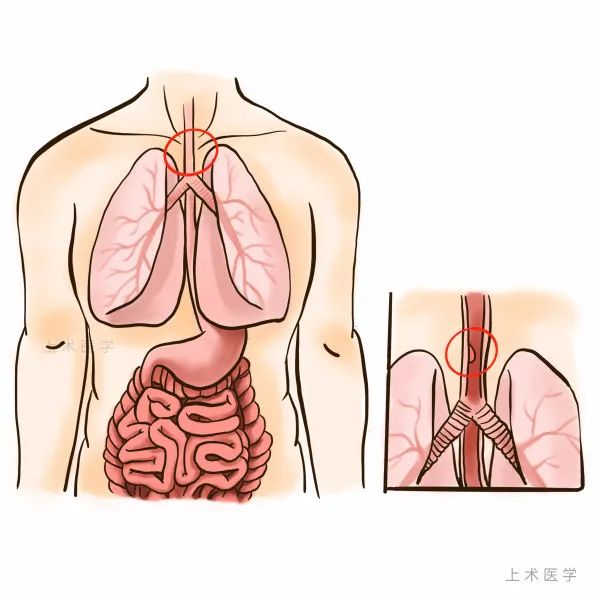 全球一半患者都在这里！一句“趁热吃”“趁热喝”伤害了多少人