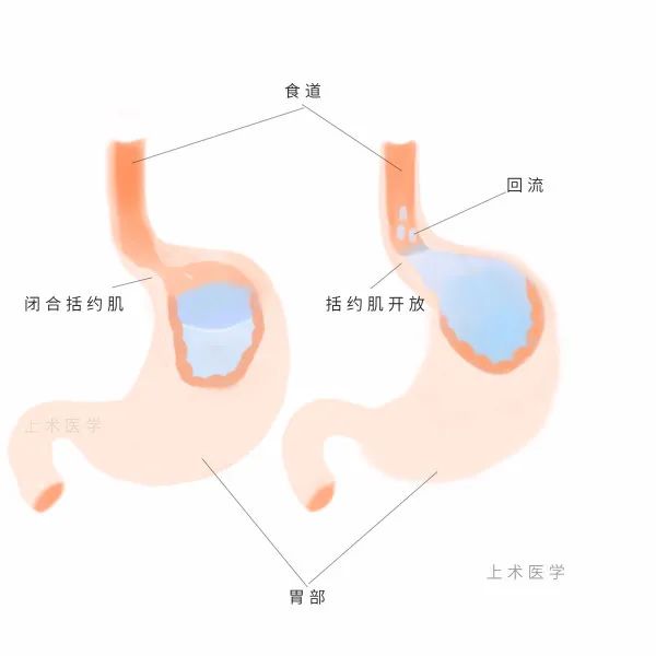 反复咳嗽、气喘、声嘶，元凶竟是胃食管反流病！