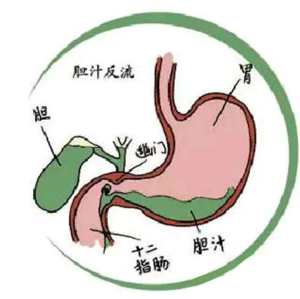 胃一直胀气，胃镜检查结果是胆汁返流该怎么办？