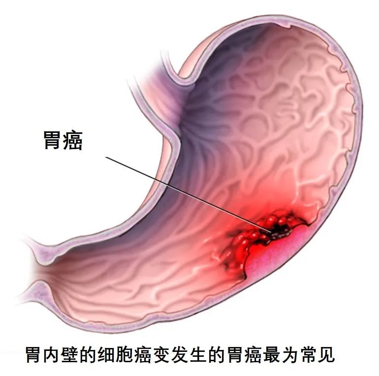 危险！90后的也检查出胃癌了，竟然因为这些坏习惯