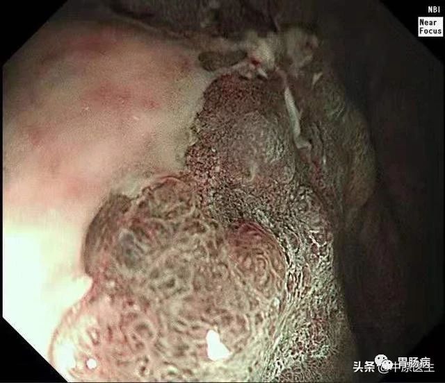 到底是胃癌，还是胃溃疡？