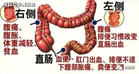 消化科医生提醒：这样的大便，可能预示着大肠癌上身！