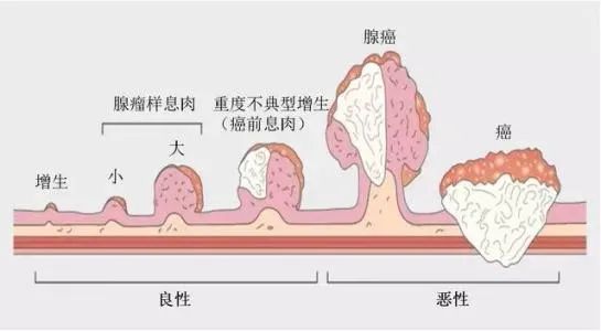 得了胃溃疡，反复发作怎么办？这几点你应该知道