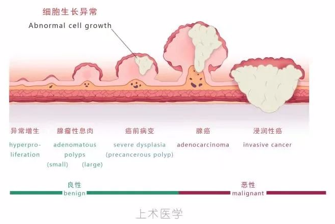 肠癌，就是个傻子癌！好防，也好治！