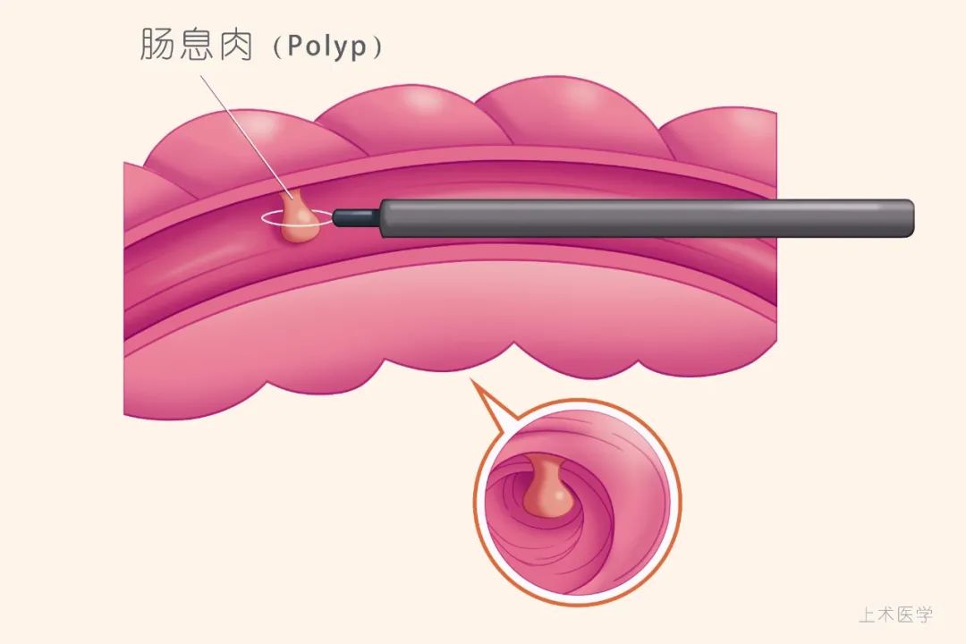 胃肠息肉原来是这么长出来的