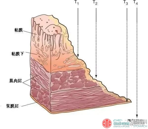 消化科医生提醒：这种“糜烂性胃炎”，是癌前病变