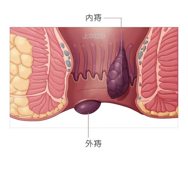 别不把痔疮当回事，小心是“直肠癌”！