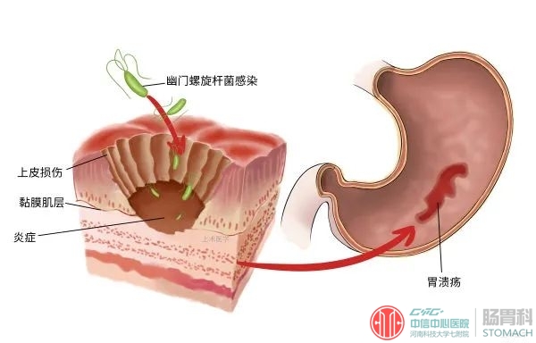 胃溃疡有哪些危害？五大危害让人不得不防