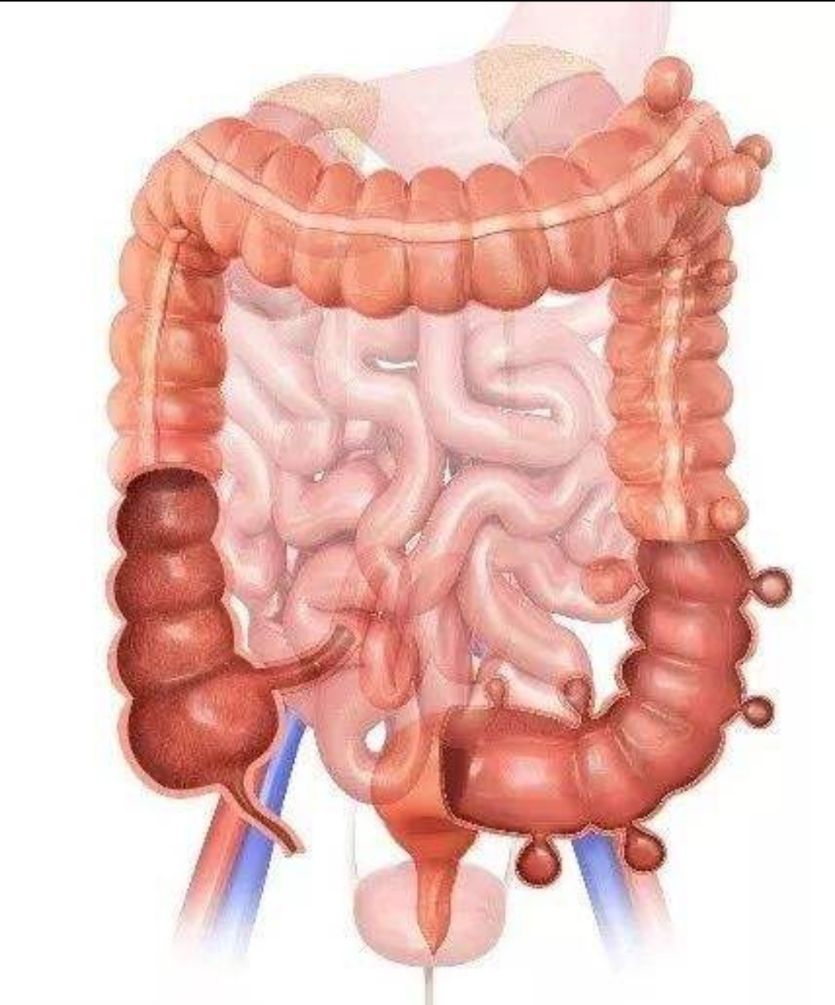 结肠憩室的症状及危害 结肠憩室要治疗多长时间