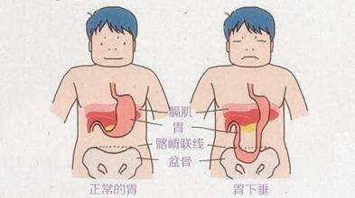 胃下垂如何科学合理的散步