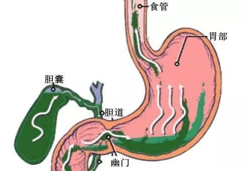 胆汁反流性胃炎严重吗