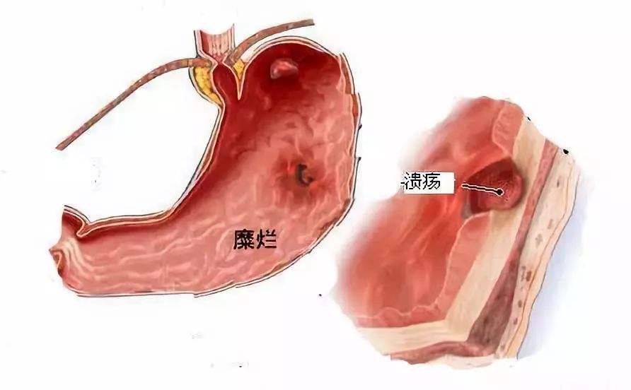 如何预防胃溃疡和十二指肠溃疡?