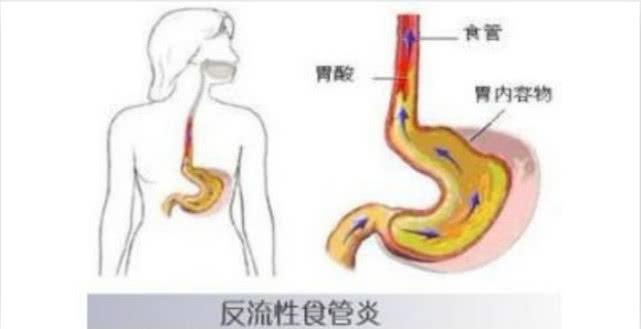 反流性食管炎最佳食谱是什么？食管炎喉咙整天堵着怎么办？