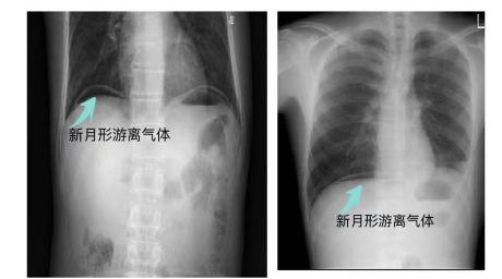 消化道穿孔患者的护理，这些方面很重要！