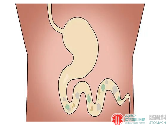 生活习惯对年轻人胃健康的影响：毁坏一个胃需要多长时间？