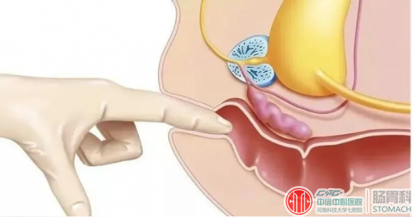 令人尴尬的“肛门指检”，一查就是3种病！你还拒绝吗？